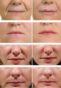 Przywrócenie jędrności i elastyczności skóry twarzy