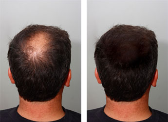 Wzmocnienie i regeneracja cebulek włosowych